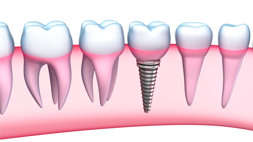 Despre implantul dentar